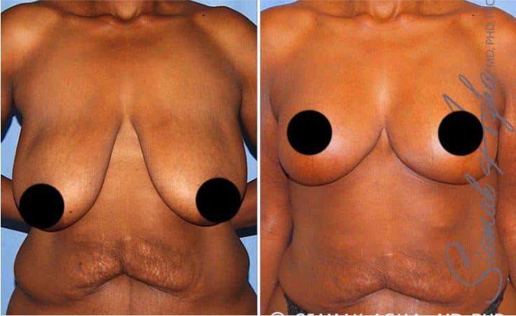 Breast Lift