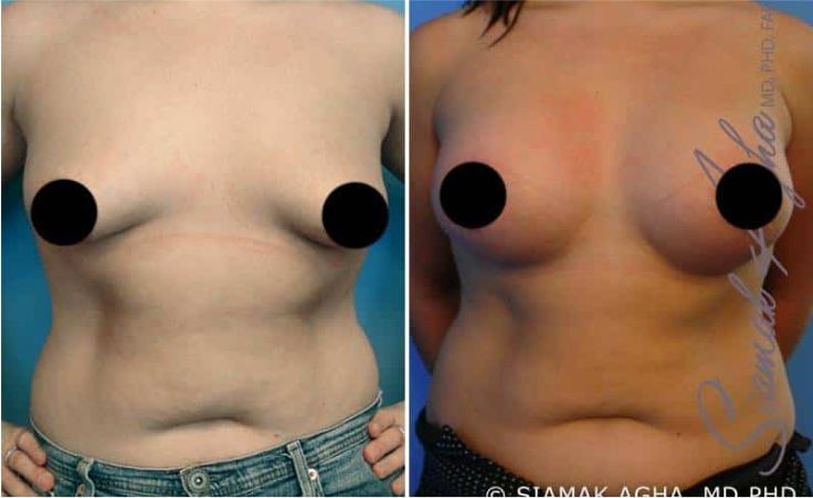 Tubular Breast Correction