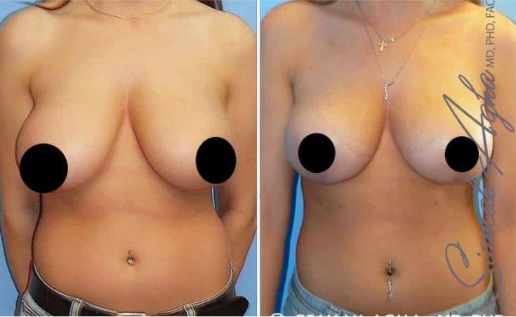Breast Reduction