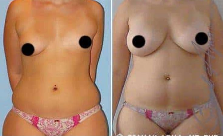 Breast Fat Transfer