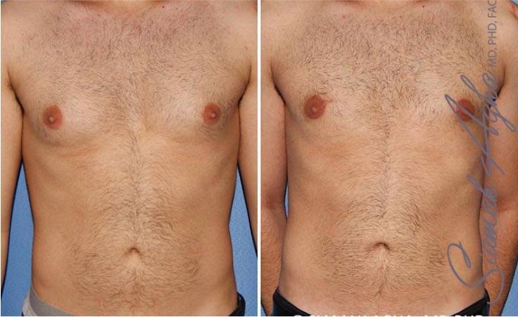 Gynecomastia Correction