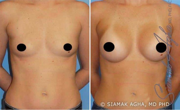 Breast Augmentation